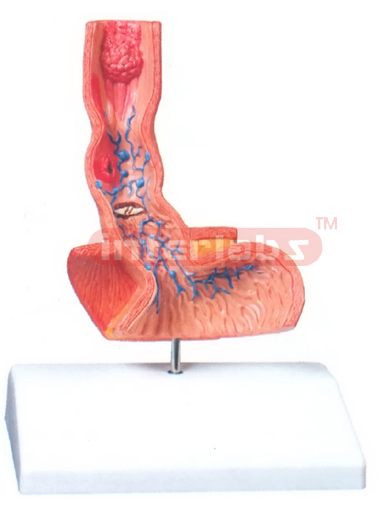 DISEASES OF THE OESOPHAGUS